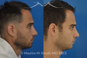 Photo of a patient before and after a procedure. Left sided nasal valve repair with spreader