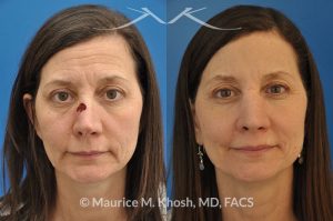 Photo of a patient before and after a procedure. Nose reconstruction - Rhinoplasty for Mohs skin defect of nose after skin cancer removal.