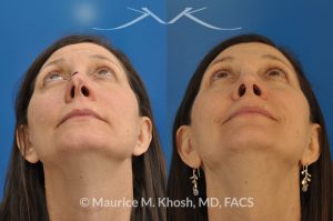 Photo of a patient before and after a procedure. Nose reconstruction - Rhinoplasty for Mohs skin defect of nose after skin cancer removal.