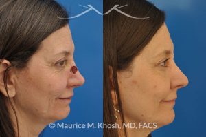 Photo of a patient before and after a procedure. Nose reconstruction - Rhinoplasty for Mohs skin defect of nose after skin cancer removal.