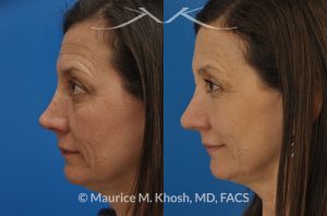 Photo of a patient before and after a procedure. Nose reconstruction - Rhinoplasty for Mos skin defect of nose after skin cancer removal.