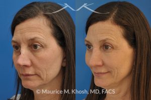 Photo of a patient before and after a procedure. Nose reconstruction - Rhinoplasty for Mohs skin defect of nose after skin cancer removal.