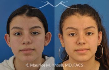 Before and After Pic of Young Lady After Ear Pinning Surgery New York NY