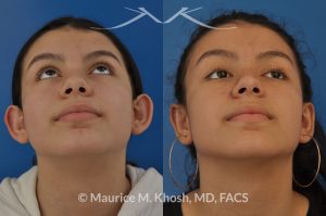 Photo of a patient before and after a procedure. Otoplasty - ear set back for protruding ears.