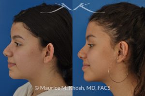 Photo of a patient before and after a procedure. Otoplasty - ear set back for protruding ears.