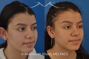 Photo of a patient before and after a procedure. Otoplasty - ear set back for protruding ears.