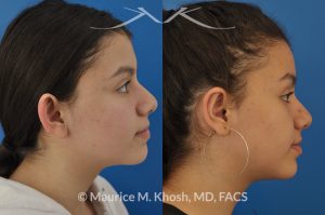 Photo of a patient before and after a procedure. Otoplasty - ear set back for protruding ears.