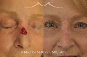 Photo of a patient before and after a procedure. Repair of Moh's skin cancer defect of nose - Reconstruction of nose after basal cell cancer excision.