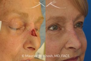 Photo of a patient before and after a procedure. Repair of Moh's skin cancer defect of nose - Reconstruction of nose after basal cell cancer excision.