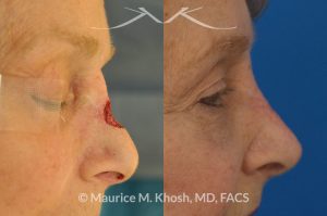 Photo of a patient before and after a procedure. Repair of Moh's skin cancer defect of nose - Reconstruction of nose after basal cell cancer excision.