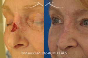 Photo of a patient before and after a procedure. Repair of Moh's skin cancer defect of nose - Reconstruction of nose after basal cell cancer excision.