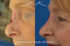 Photo of a patient before and after a procedure. Repair of Moh's skin cancer defect of nose - Reconstruction of nose after basal cell cancer excision.