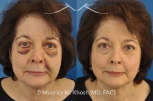 Photo of a patient before and after a procedure. Resetting a broken nose - Closed reduction of nose fracture.