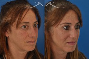 Photo of a patient before and after a procedure. This 52 year-old lady was unhappy with droopy and puffy upper eyelids which prevented her from applying eye shadow. She underwent upper eyelid lift, upper blepharoplasty, to get rid of excess skin in the upper eyelid.