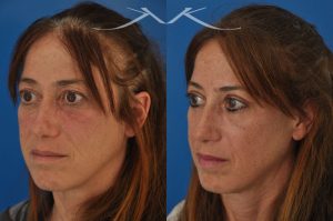 Photo of a patient before and after a procedure. This 52 year-old lady was unhappy with droopy and puffy upper eyelids which prevented her from applying eye shadow. She underwent upper eyelid lift, upper blepharoplasty, to get rid of excess skin in the upper eyelid.