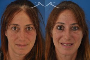 Photo of a patient before and after a procedure. This 52 year-old lady was unhappy with droopy and puffy upper eyelids which prevented her from applying eye shadow. She underwent upper eyelid lift, upper blepharoplasty, to get rid of excess skin in the upper eyelid.