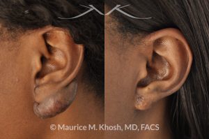 Photo of a patient before and after a procedure. Keloid Ear