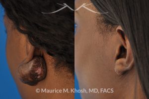 Photo of a patient before and after a procedure. Keloid Ear