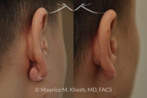 Keloid scar removal from the back side of the earlobe - before and after.