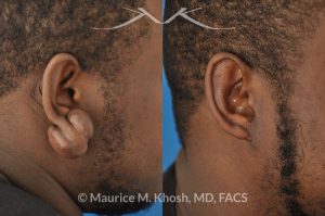 Photo of a patient before and after a procedure. Large keloid - scar removal from the earlobe.