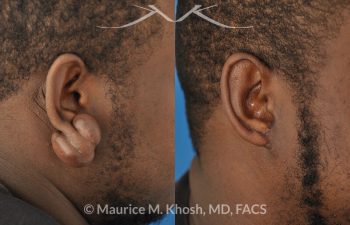 Large keloid scar removal from the earlobe - before and after.