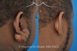 Photo of a patient before and after a procedure. Large keloid - scar removal from the earlobe.