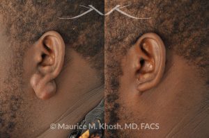 Photo of a patient before and after a procedure. Large keloid - scar removal from the earlobe.