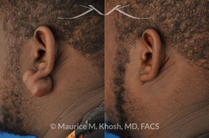 Photo of a patient before and after a procedure. Large keloid - scar removal from the earlobe.