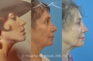 Photo of a patient before and after a procedure. Revision rhinoplasty with rib cartilage graft - This lovely patient had undergone rhinoplasty in her 30′s. She disliked the appearance of her nose and had difficulty breathing from the right side of her nose. She underwent revision rhinoplasty with rib cartilage graft to improve her nasal tip definition and improve her breathing function. The profile picture  with three images shows her nasal appearance before her original surgery, followed by her pre and post operative results after revision rhinoplasty. 