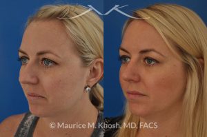 Photo of a patient before and after a procedure. Bilateral repair - Bilateral repair of nasal valve with spreader grafts, tip rhinoplasty.