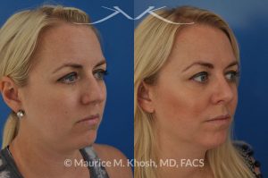 Photo of a patient before and after a procedure. Bilateral repair - Bilateral repair of nasal valve with spreader grafts, tip rhinoplasty.