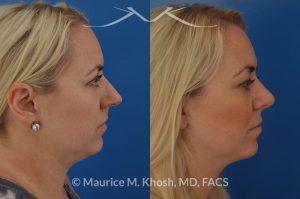 Photo of a patient before and after a procedure. Bilateral repair - Bilateral repair of nasal valve with spreader grafts, tip rhinoplasty.