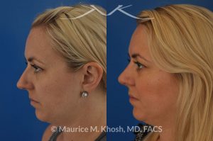 Photo of a patient before and after a procedure. Bilateral repair - Bilateral repair of nasal valve with spreader grafts, tip rhinoplasty.