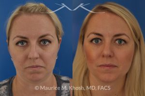 Photo of a patient before and after a procedure. Bilateral repair - Bilateral repair of nasal valve with spreader grafts, tip rhinoplasty.