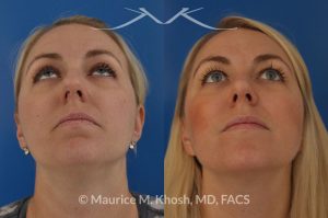 Photo of a patient before and after a procedure. Bilateral repair - Bilateral repair of nasal valve with spreader grafts, tip rhinoplasty.