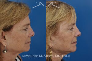 Photo of a patient before and after a procedure. Revison rhinoplasty to straighten a twisted tip - This lovely patient had rhinoplasty many years ago. She had skin cancer removed from the tip of her nose over five years ago. This resulted in a twisted and asymmetric nasal tip. The nasal tip was repaired during an open revision rhinoplasty, utilizing rib cartilage grafts.