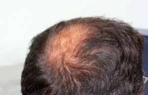Man's Bald Spot New York NY