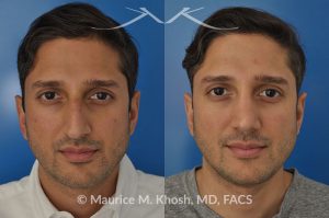 Photo of a patient before and after a procedure. Open approach rhinoplasty to reduce a large hump and elevate a droopy tip, as well as septopalsty to improve breathing