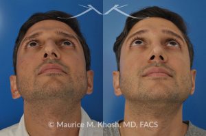 Photo of a patient before and after a procedure. Open approach rhinoplasty to reduce a large hump and elevate a droopy tip, as well as septopalsty to improve breathing
