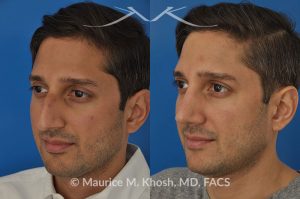 Photo of a patient before and after a procedure. Open approach rhinoplasty to reduce a large hump and elevate a droopy tip, as well as septopalsty to improve breathing