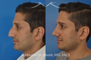 Photo of a patient before and after a procedure. Open approach rhinoplasty to reduce a large hump and elevate a droopy tip, as well as septopalsty to improve breathing