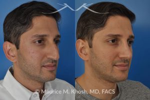 Photo of a patient before and after a procedure. Open approach rhinoplasty to reduce a large hump and elevate a droopy tip, as well as septopalsty to improve breathing