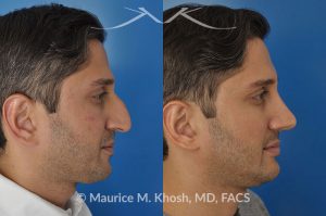 Photo of a patient before and after a procedure. Open approach rhinoplasty to reduce a large hump and elevate a droopy tip, as well as septopalsty to improve breathing