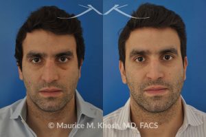 Photo of a patient before and after a procedure. Closed reduction of nose fracture, re-setting a proken nose as an office procedure