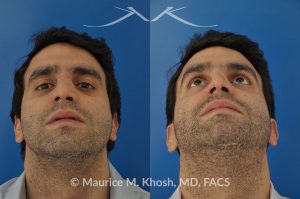 Photo of a patient before and after a procedure. Closed reduction of nose fracture, re-setting a proken nose as an office procedure