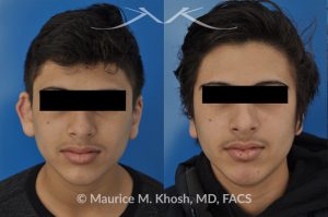 Photo of a patient before and after a procedure. Ear pinning (otoplasty)