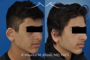 Photo of a patient before and after a procedure. Ear pinning (otoplasty)