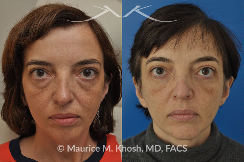 Puffy Eyes and Bags with Eyelid Surgery