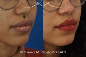 Photo of a patient before and after a procedure. Mole removal from upper lip