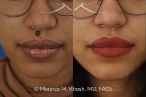 Photo of a patient before and after a procedure. Mole removal from upper lip